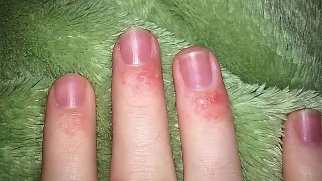 Аллергия на гель-лак и косметику для ногтей на пальцах рук: подробное руководство Аллергия на гель-лак и косметику для ногтей на пальцах рук: подробное руководство